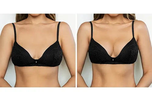 Augmentation mammaire suite opération