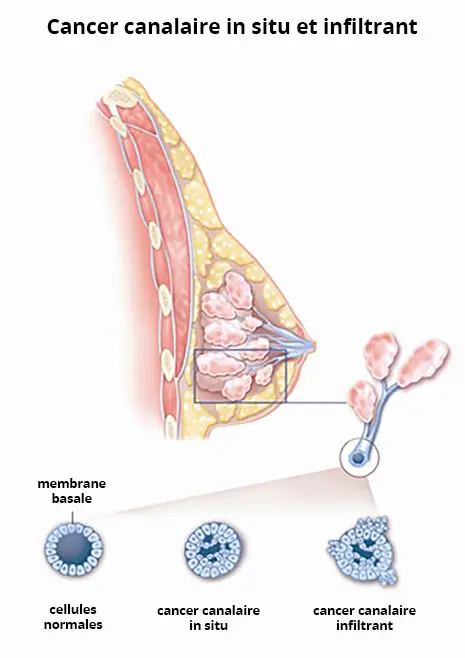 Cancer du sein canalaire in situ