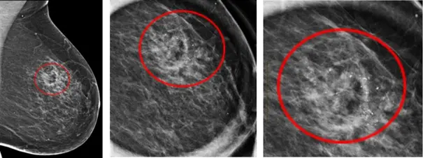 Cancer du sein dépistage & diagnostique