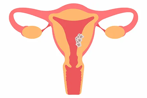 Diagnostic du cancer de l’endomètre