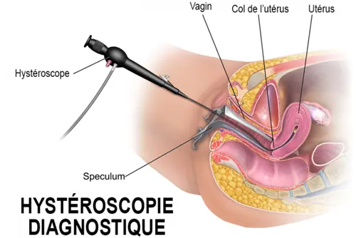 hystéroscopie
