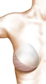 reconstruction-grand-dorsal-heterologue