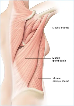 Reconstruction mammaire par lambeau de grand dorsal